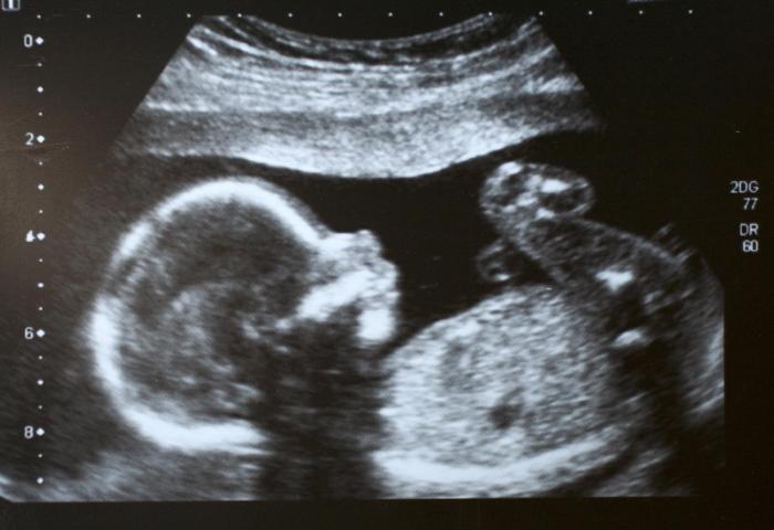 Baby Growth Scan